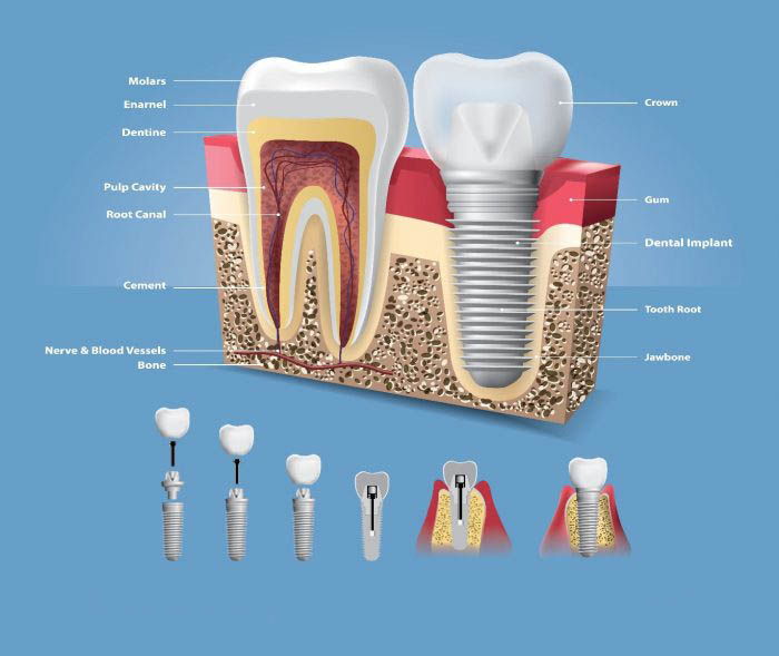 Зубы импланты поэтапно. Имплантат абатмент коронка формирователь. Этапы имплантации зуба абатмент. Вставка имплантов зубов.